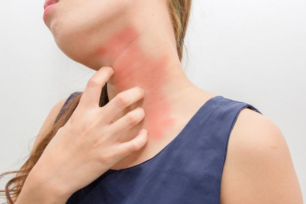 Không dung nạp histamine