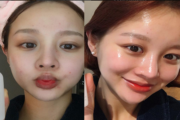 8 loại dưỡng ẩm dạng gel thấm nhanh ẩm mượt cực phù hợp cho da mụn