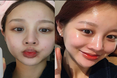 8 loại dưỡng ẩm dạng gel thấm nhanh ẩm mượt cực phù hợp cho da mụn