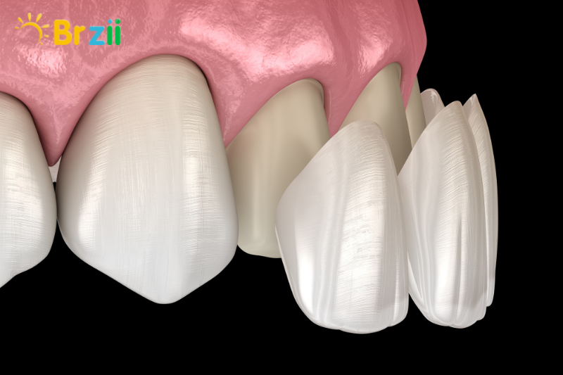 Không ảnh hưởng đến cấu trúc răng thật